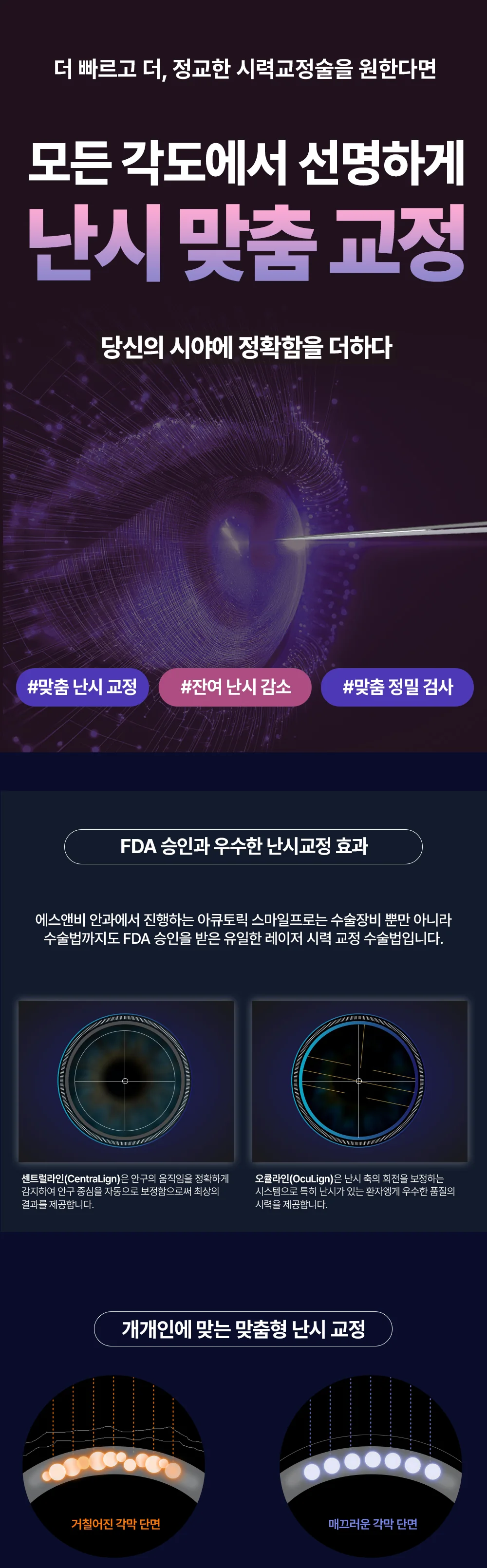 라식에서 난시 맞춤 교정과 잔여 난시 감소를 설명하는 S&B안과 안내 이미지