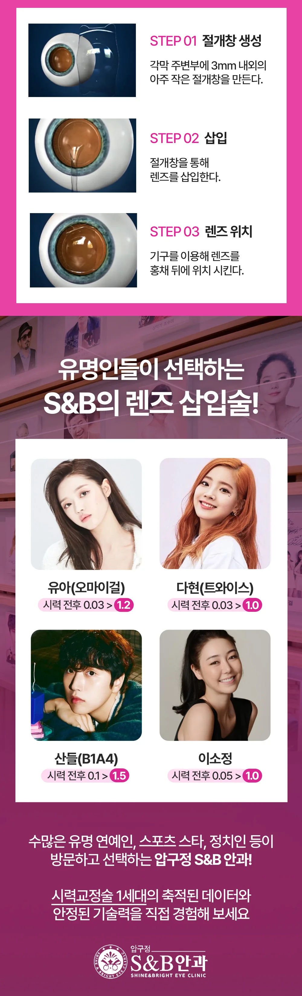 렌즈삽입술 과정과 S&B안과 수술 사례를 안내하는 이미지
